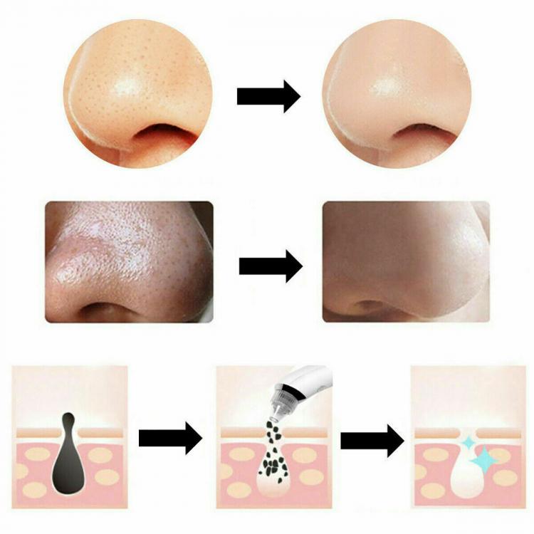 ASPIRATORE PUNTI NERI 4 TESTINE RIMUOVI PORI NASALI E ACNE VISO PULIZIA FACCIALE