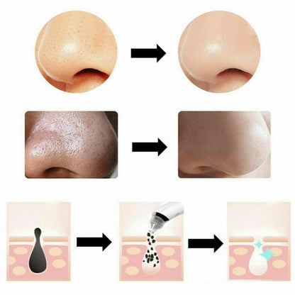 ASPIRATORE PUNTI NERI 4 TESTINE RIMUOVI PORI NASALI E ACNE VISO PULIZIA FACCIALE